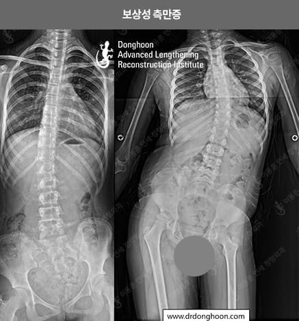 하지부동으로 골반이 기울어진 상태에서 몸을 바로 세우기 위해 척추가 휘는 ‘보상성 측만증’