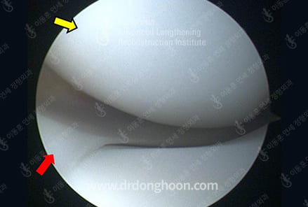 정상 관절 — 대퇴골 연골(노랑)과 정상 반월상 연골판(빨강)