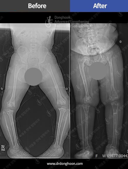 골이형성증(epiphyseal dysplasia)으로 인한 소아 휜다리 치료