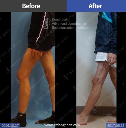 외상 후 생긴 허벅지뼈의 굴곡변형 교정
