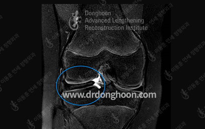 완전 원판형 연골판 MRI(파란 원)