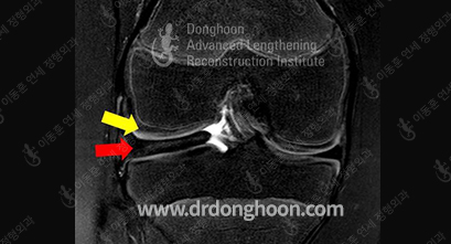 MRI — 연골(노랑)과 원판형 연골판(빨강)