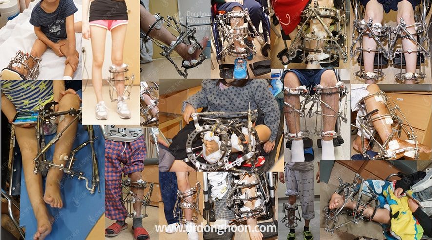 SUV 컴퓨터 외고정장치를 이용한 복합변형의 치료