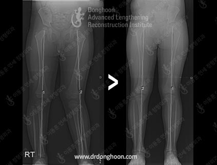 소아 엑스다리가 아무 치료 없이 저절로 교정되는 과정